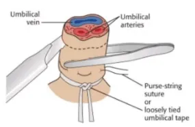 Umbilical Vein Catheterization (UVC) Kit