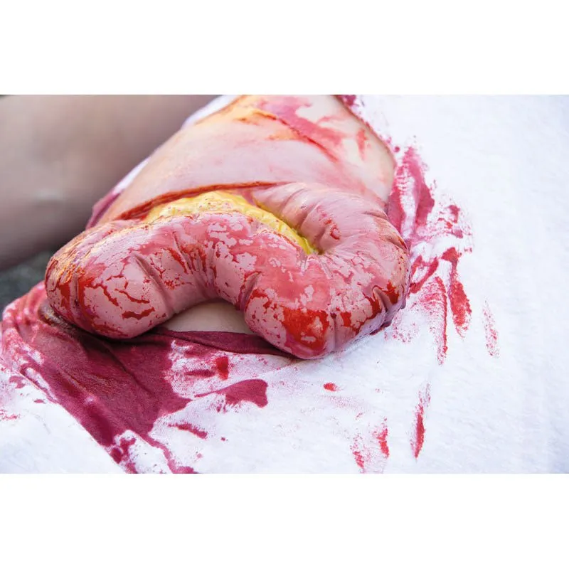 Wound Moulage Protruding of small and large intestines